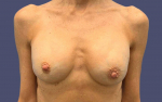 Breast Lift w/ Augmentation 12 Before